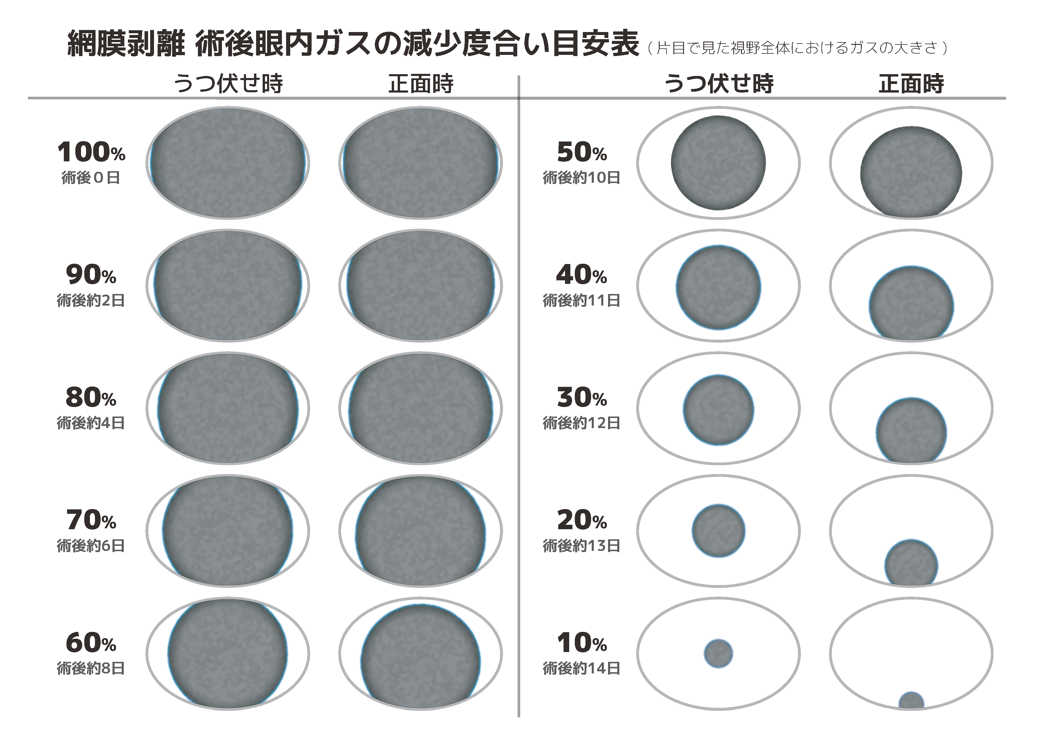 網膜剥離 術後眼内ガスの減少度合い目安表｣の制作